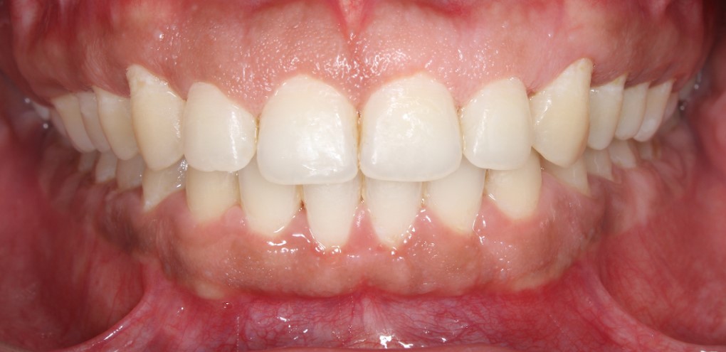 After treatment