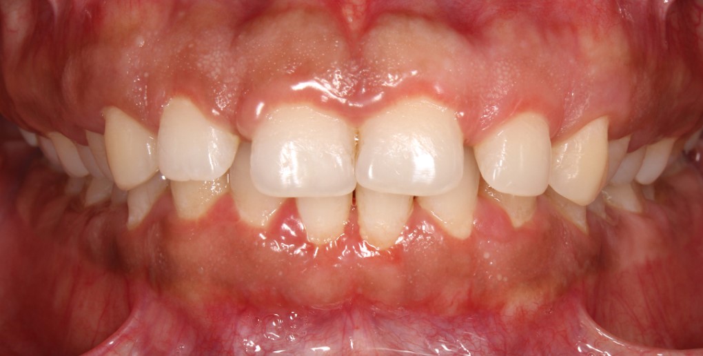 Before treatment